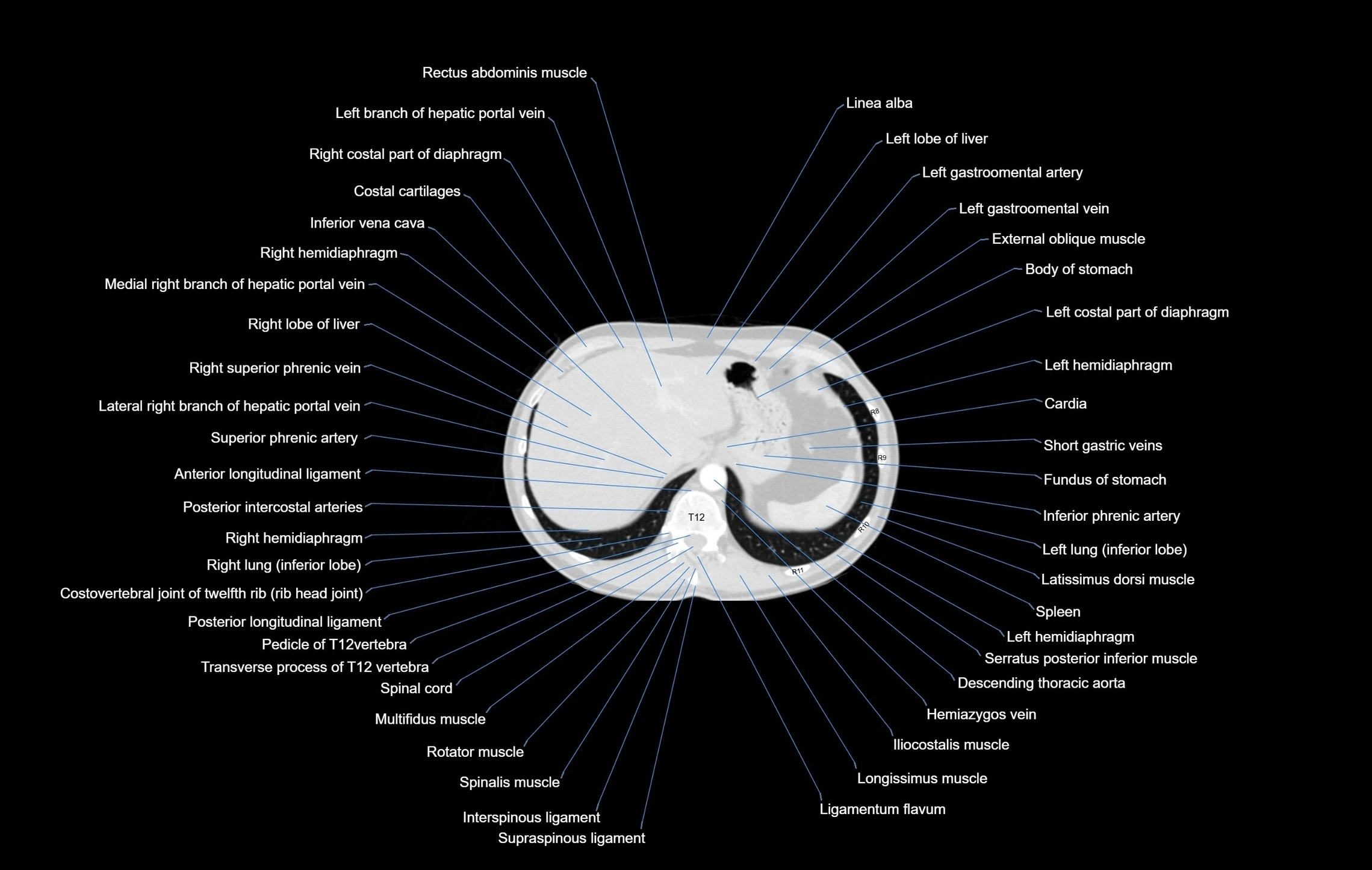 CT chest (thorax) labelled axial cross sectional anatomy radiology image-00109.webp